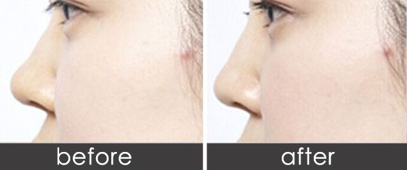 鼻部整形术前都需要准备什么呢？