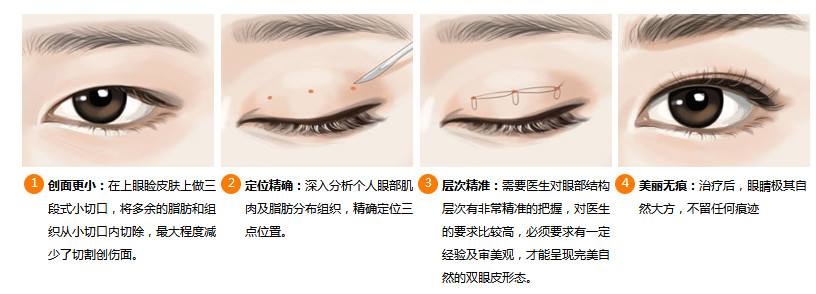 微创双眼皮手术有效果吗？