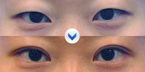 双眼皮手术顺利的标准是什么？