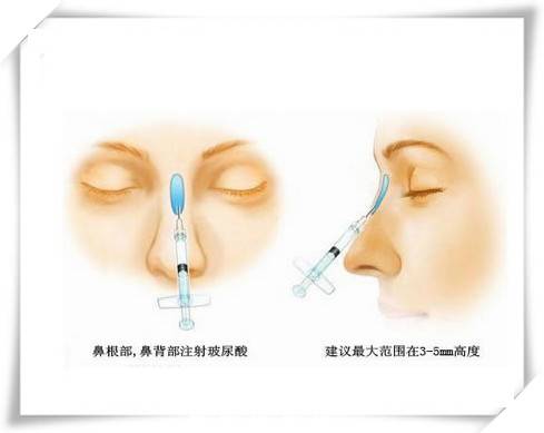 哪种隆鼻的的方式效果比姣好呢？